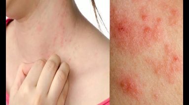 How to Deal with Winter Eczema | Natural Treatment of Eczema 16 1681351739 maxresdefault