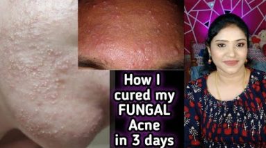 Fungal ACNE Cure | நெற்றியில் பொறி பொறியாக உள்ளதா? இதை Try பண்ணுங்க! 100% Effective Skincare 8 1681353481 hqdefault