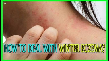 How To Deal With Winter Eczema - How To Stop Eczema Itching? | Best Home Remedies 14 1681357047 maxresdefault