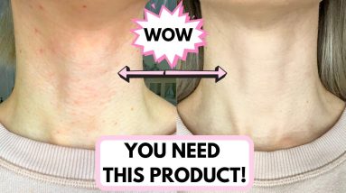 HOW TO GET RID OF SKIN IRRITATION CAUSED BY RETINOL 12 1681368194 maxresdefault