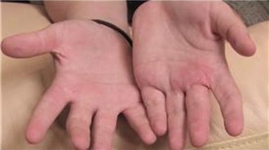 Dermatology Treatments : Probiotic Treatment of Eczema 4 1681370212 hqdefault