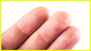 How to Eliminate Eczema Naturally 4 1681375479 maxresdefault