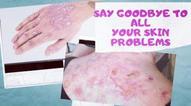 GET RID OF ECZEMA, RASHES, SKIN INFECTIONS WITHOUT BUYING ANY MEDICATIONS. 18 1681386738 hqdefault