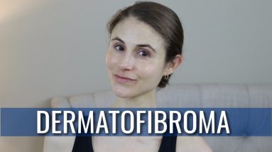 DERMATOFIBROMA: WHAT IS IT? HOW IS IT TREATED? | DR DRAY 14 1681394208 maxresdefault