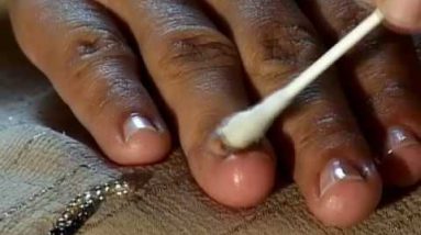 How to Cure Nail Fungus 12 1681397890 hqdefault
