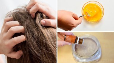 3 Home Remedies for Itchy Scalp Tried and Tested 18 1681409236 maxresdefault