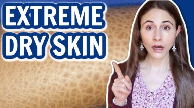 SIGNS OF EXTREME DRY SKIN // ICHTHYOSIS VULGARIS @DrDrayzday 10 1681411420 maxresdefault
