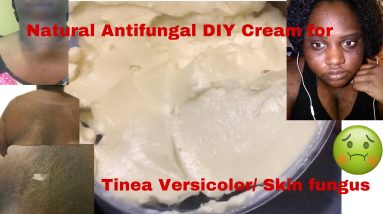 DIY NATURAL SKIN FUNGAL CREAM TO TREAT TINEA VERSICOLOR AND ECZEMA 20 1681416688 maxresdefault