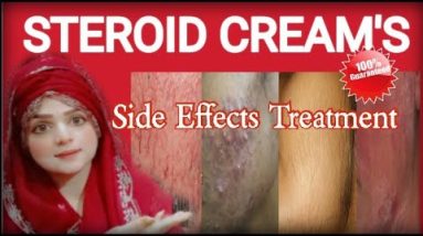 Steroid Cream's Side effects Treatment | Eczema Treatment 18 1681420362 hqdefault