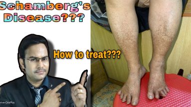 Schamberg’s disease/treatment/prevention ( black spots on legs (पाँव में काला दाग) 10 1681439038 maxresdefault