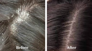 Get Rid of Dandruff With This Natural Home Remedies 8 1681442758 maxresdefault