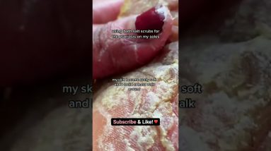 😮 it was so painful #sgtiktok #psoriasis #psoriasisawareness #trending #eczema #skincare #shorts 2 1681450528 maxresdefault