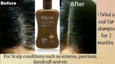 How I got rid of my scalp condition *psoriasis,eczema and heavy dandruff. (Life changing product)💫 6 1681483723 hqdefault