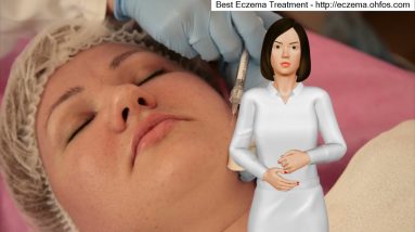 Common Treatment For Eczema 20 1681494909 maxresdefault