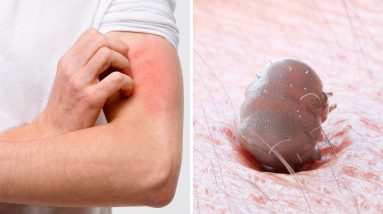 9 Reasons Your Skin Has Red Spots and Bumps 18 1681498581 maxresdefault