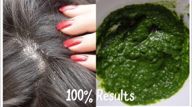 BEST SEBORRHEIC DERMATITIS SCALP TREATMENT | AYURVEDIC DANDRUFF TREATMENT 100% RESULTS IN ONE USE 12 1681509788 maxresdefault