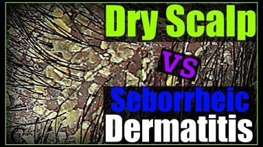 How to Get Rid of Dandruff (Seborrheic Dermatitis) & Dry Scalp 6 1681521043 maxresdefault