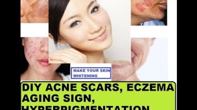 DIY SKIN WHITENING SERUM, REMOVING ACNE SCARS, HYPERPIGMENTATION, AGING SIGN, ECZEMA 4 1681524868 hqdefault