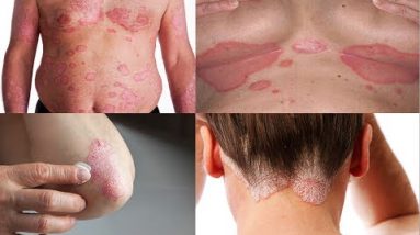 5 Home Remedies for Eczema and Psoriasis Relief 10 1681624640 hqdefault