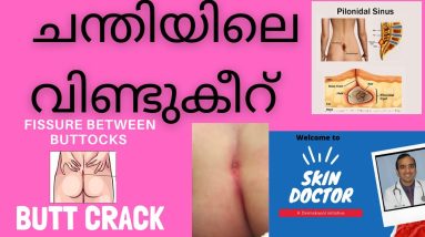 ചന്തിയിലെ കീറ് /Butt crack with English subtitles /intertrigo /fissure in gluteal fold /malayalam 4 1681635700 maxresdefault
