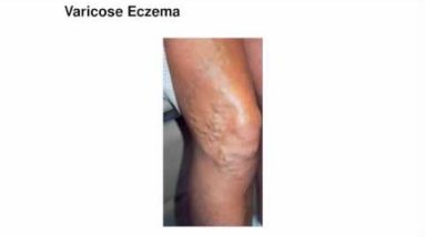 ECZEMA-FREE-FOREVER-REVIEW.COM 14 1681654177 hqdefault