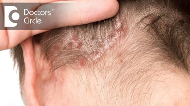 What is the management of Scalp Psoriasis? - Dr. Rashmi Ravindra 12 1681657834 maxresdefault