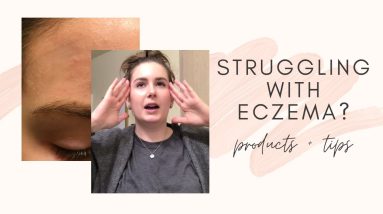 Facial Eczema? Here’s how to fix it quickly 8 1681662929 maxresdefault