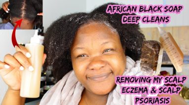 DIY African Black Soap Shampoo| How I remove my Scalp Eczema/Scalp Psoriasis| Cheapest Shampoo Ever! 8 1681671098 maxresdefault
