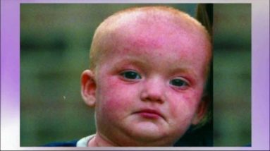 Dry Skin Treatment - Skin Salvation - Suitable for those prone to Eczema, Dermatitis, Psoriasis 20 1681685145 maxresdefault