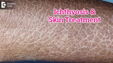 What is Ichthyosis? How to Treat my Skin?| Fish like scales On Skin-Dr.Rasya Dixit | Doctors' Circle 18 1681688776 maxresdefault