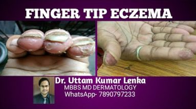 Fingertip eczema(skin peeling from tip of fingers/ उँगलियों के नोक से त्वचा फटना)(Anguthi Fatiha) 4 1681714845 hqdefault