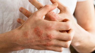Magical Drink Psoriasis,Eczema,Chambal & Blood Purifier 8 1681775800 maxresdefault