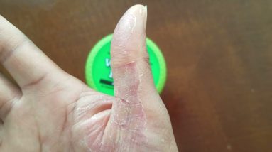 Healing Dyshidrotic Eczema Skin After Flare-up from Chemicals with O'Keeffe's Working Hands Cream 4 1681781017 maxresdefault