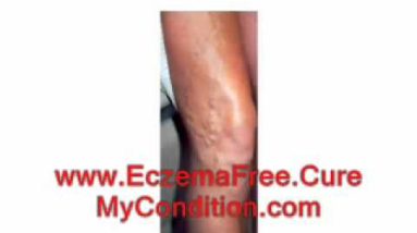 A Patient's Honest Review of Rachel Anderson's Eczema Free Forever Treatment Program - Pros and Cons 4 1681783242 hqdefault