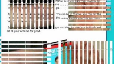 Eczema -eczema dark skin - You can do it! 20 1681790649 hqdefault