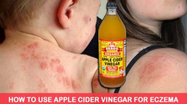 How To Use Apple Cider Vinegar To Treat Eczema, It’s Unbelievably Effective 18 1681794318 maxresdefault