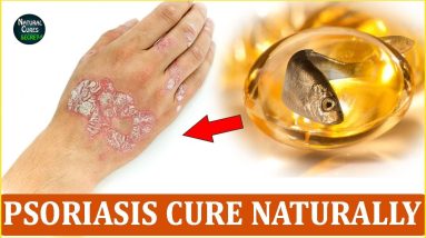 How To Cure Psoriasis Naturally | Psoriatic Arthritis Treatment at Home 8 1681812824 maxresdefault