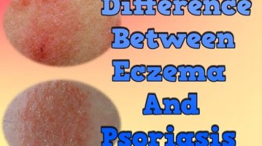 Difference Between Eczema And Psoriasis, Tea Tree Oil Psoriasis, Psoriasis On The Face 18 1681867961 hqdefault