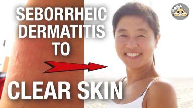 seborrheic dermatitis to clear skin (my story) 8 1681886375 maxresdefault