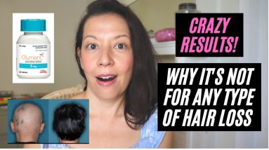 HUGE HAIR LOSS MEDICINE NEWS 🤯 BARICITINIB "OLUMIANT" FOR ALOPECIA IS FDA APPROVED. CAN I USE IT? 14 1682057581 maxresdefault