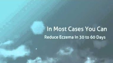 Eczema Treatment - Start Your Eczema Treatment Today 10 1682067166 hqdefault