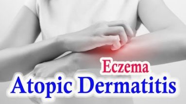 Atopic Dermatitis | Home Remedies For Atopic Dermatitis 6 1682074540 hqdefault