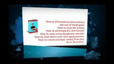 How To Cure Your Eczema | Beat Eczema 20 1682085724 hqdefault