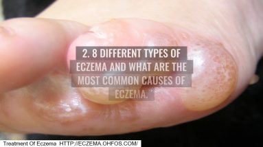 Can I Put Tea Tree Oil On Eczema 14 1682094458 maxresdefault