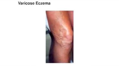 Cure Eczema Naturally In 3 Days! 14 1682096708 hqdefault