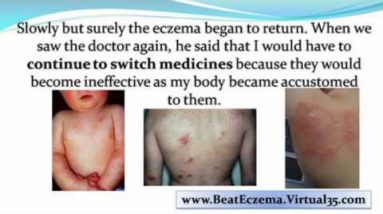 treatments for eczema - remedies for eczema - eczema in babies 8 1682114195 hqdefault