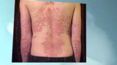 How To Get Rid Of Eczema-My honest Review 16 1682130938 hqdefault
