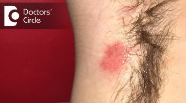 How to deal with red patches over underarms? - Dr. Swetha Sunny Paul 20 1682131111 maxresdefault