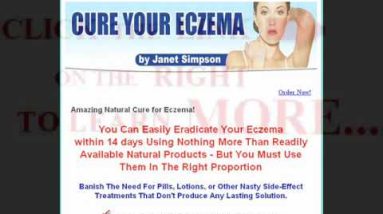 cure your eczema - cureyoureczema.com 14 1682134649 hqdefault