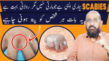 Scabies Medicine Lotion (Shadeed Kharish ka ilaj) Scabies Causes and Treatment in Urdu (Part 2) 12 1682138289 maxresdefault